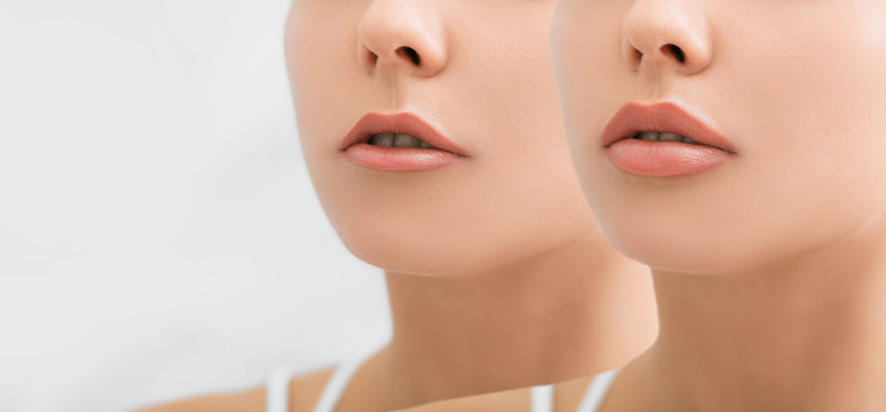 Juvéderm Lip Filler